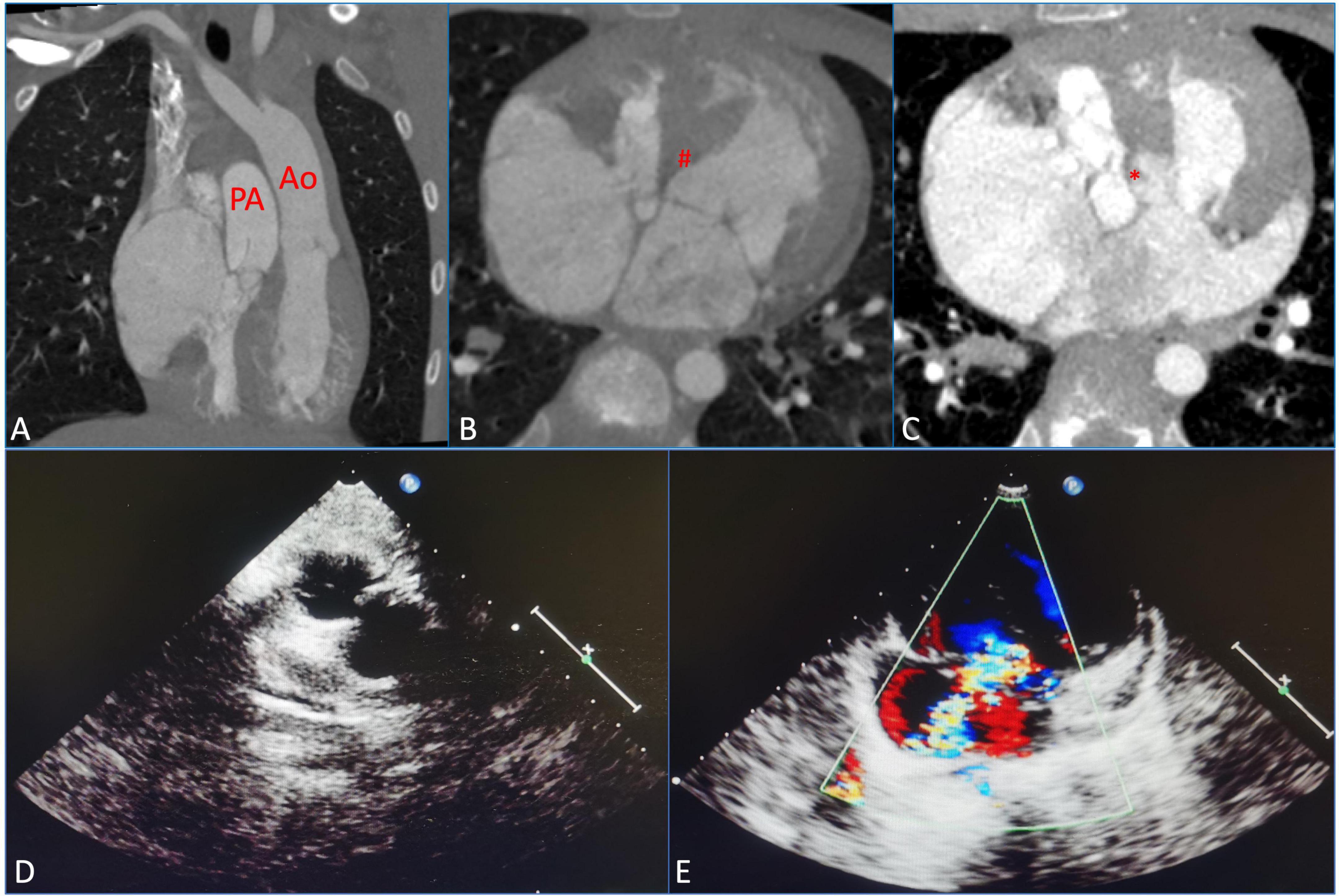 Case report: Surgical repair of congenitally corrected transposition of the great arteries with the guidance of three-dimensional printing